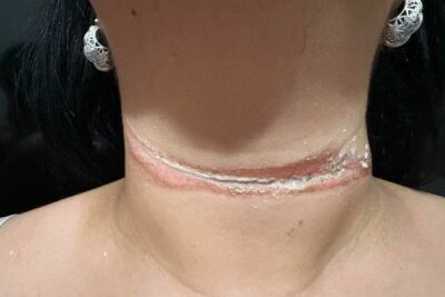 Imagem da notícia Professora de Três Lagoas quase morre enforcada por fio solto de internet